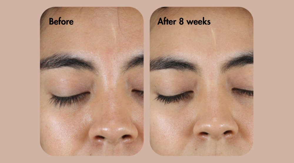 Vorher-Nachher-Vergleich einer Augenbrauenbehandlung im Gesicht einer Person.